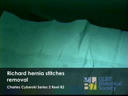 Richard hernia stitches removal